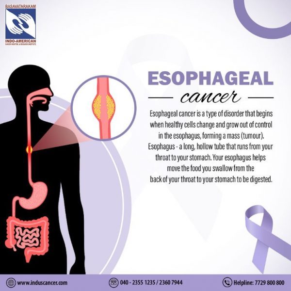 Esophageal Cancer: Causes, Symptoms, And Treatment Options At ...