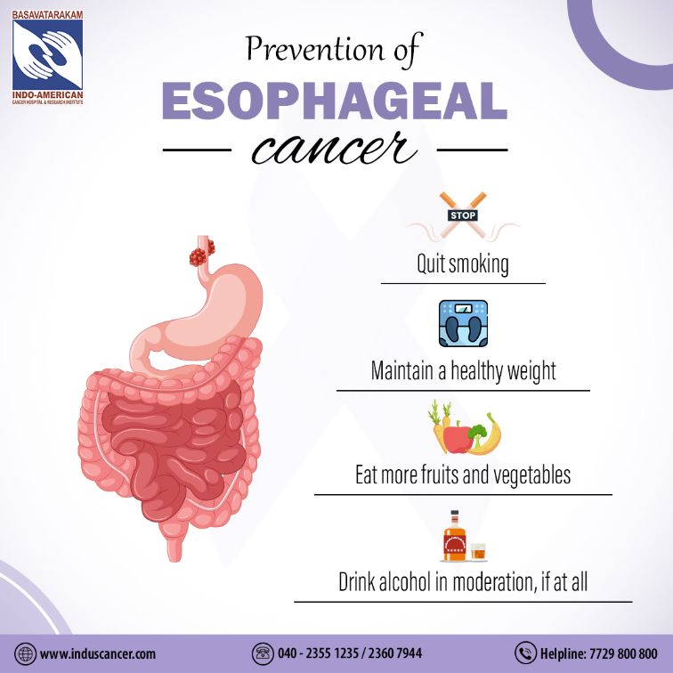 prevention of esophageal cancer