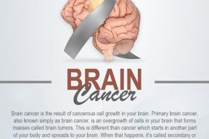 brain cancer - BRAIN TUMORS