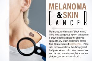 melanoma and skin cancer