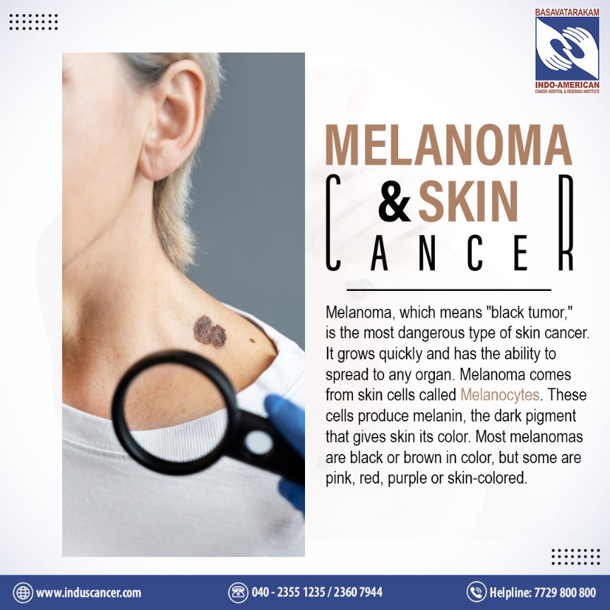Melanoma And Skin Cancer Causes And Risk Factors Symptoms And