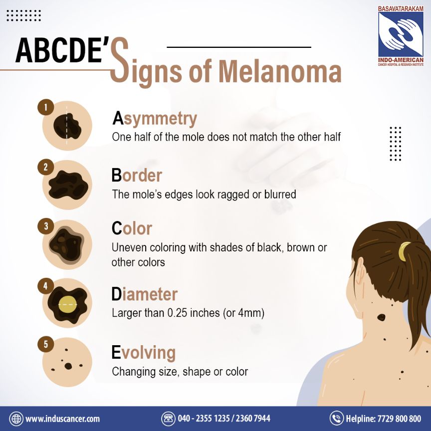 signs of melanoma