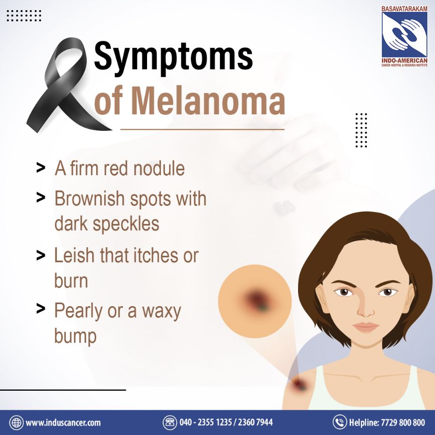 symptoms of melanoma