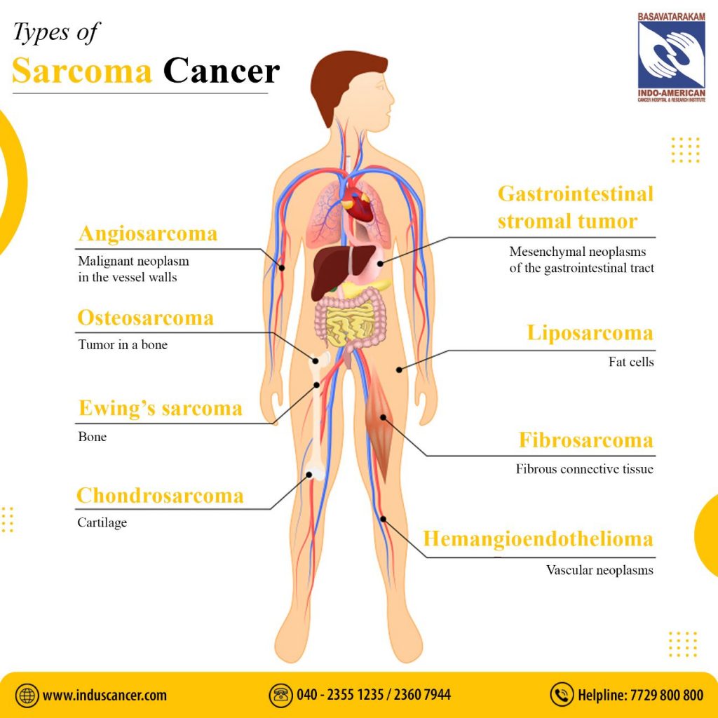 Types of Sarcoma Cancer