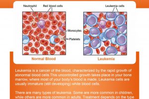 Comprehensive Guide to Leukemia Symptoms, Causes, Treatment, Types, Diagnosis, and Risk Factors