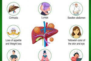 Signs and Symptoms of Liver Cancer