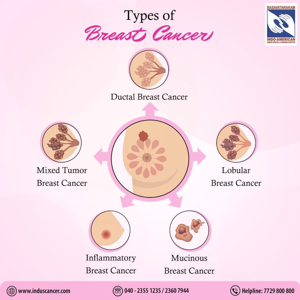 tyes of breast cancer