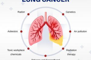 Risk factors of Lung Cancer