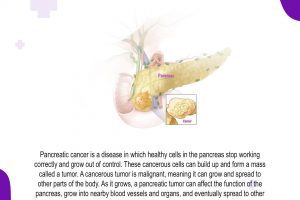 What is Pancreatic Cancer