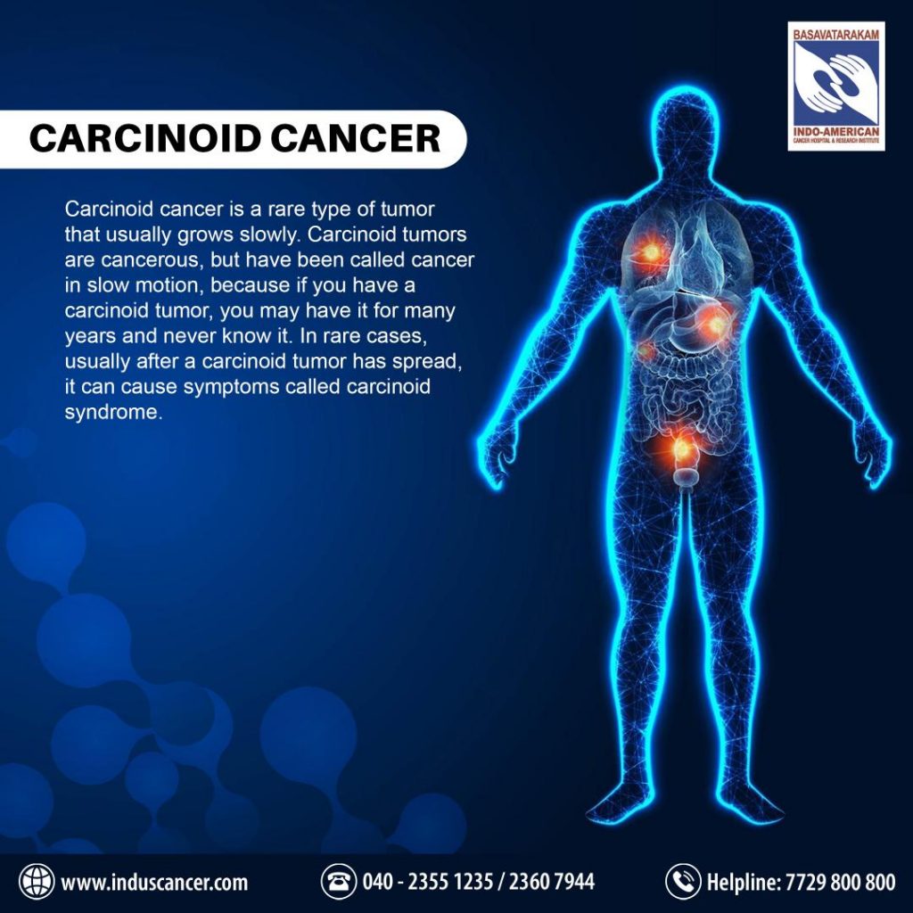 What is Carcinoid Cancer: