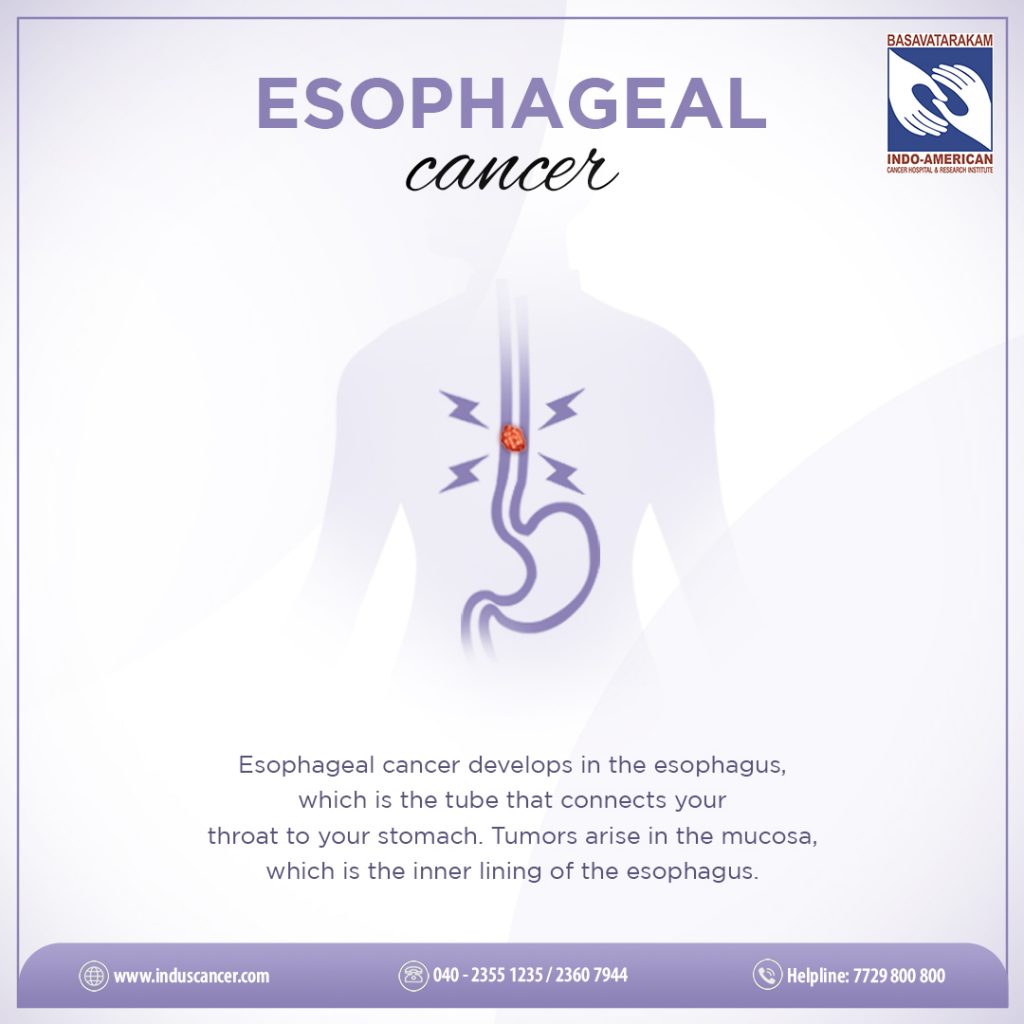 about esophageal cancer - Basavatarakam Indo American Cancer Hospital